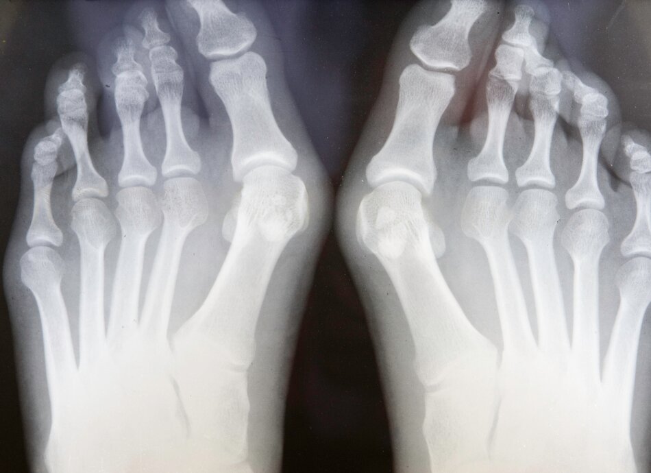 X-ray of bunions on feet