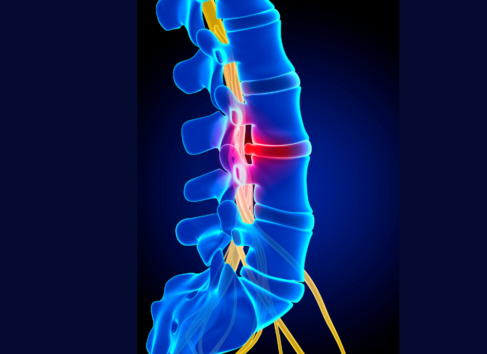 Graphic illustration of herniated disk in spine