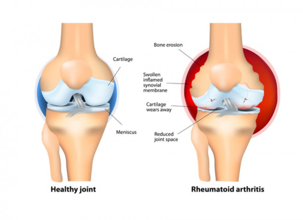 A healthy joint and a joint with rheumatoid arthritis