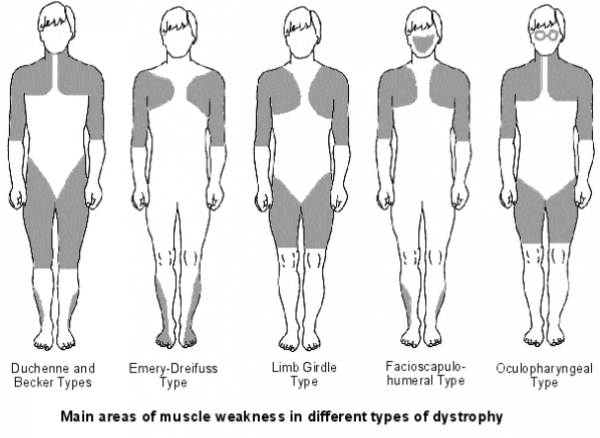 Location of muscle weakness associated with the different types of dystrophy