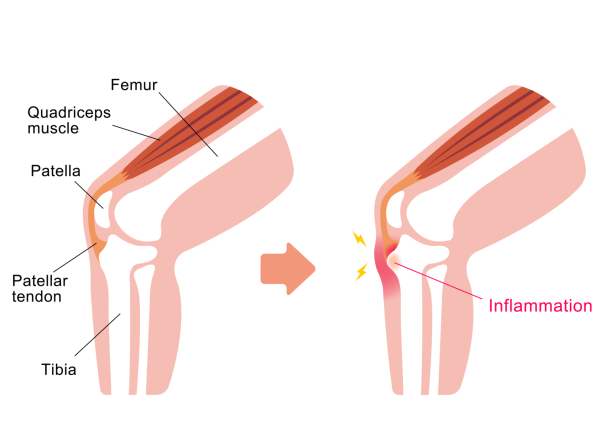 Image of knee anatomy showing the area affected by Osgood-Schlatter disease