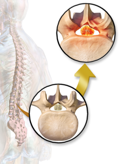 Image showing spine and inserts of normal spine and spinal stenosis