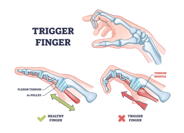 Trigger finger mechanism