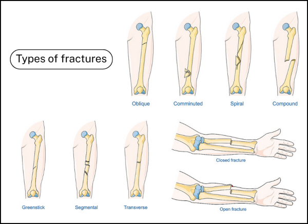 The different types of bone fractures