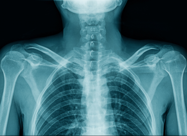 Upper body x-ray showing different densities of body parts