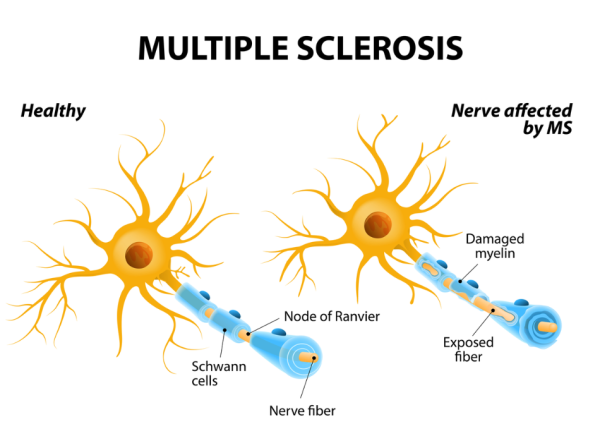 Healthy nerve and nerve affected by MS