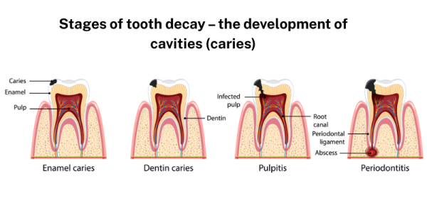 Image showing the stages of tooth decay