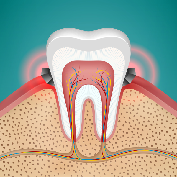 Gingivitis with plaque building up and causing red, sore gumline