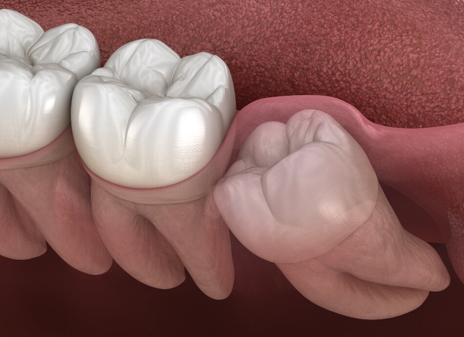Graphic illustration of impacted wisdom tooth