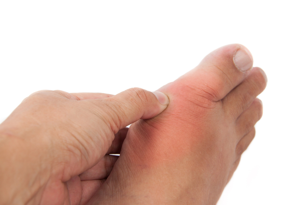 Gout on right foot