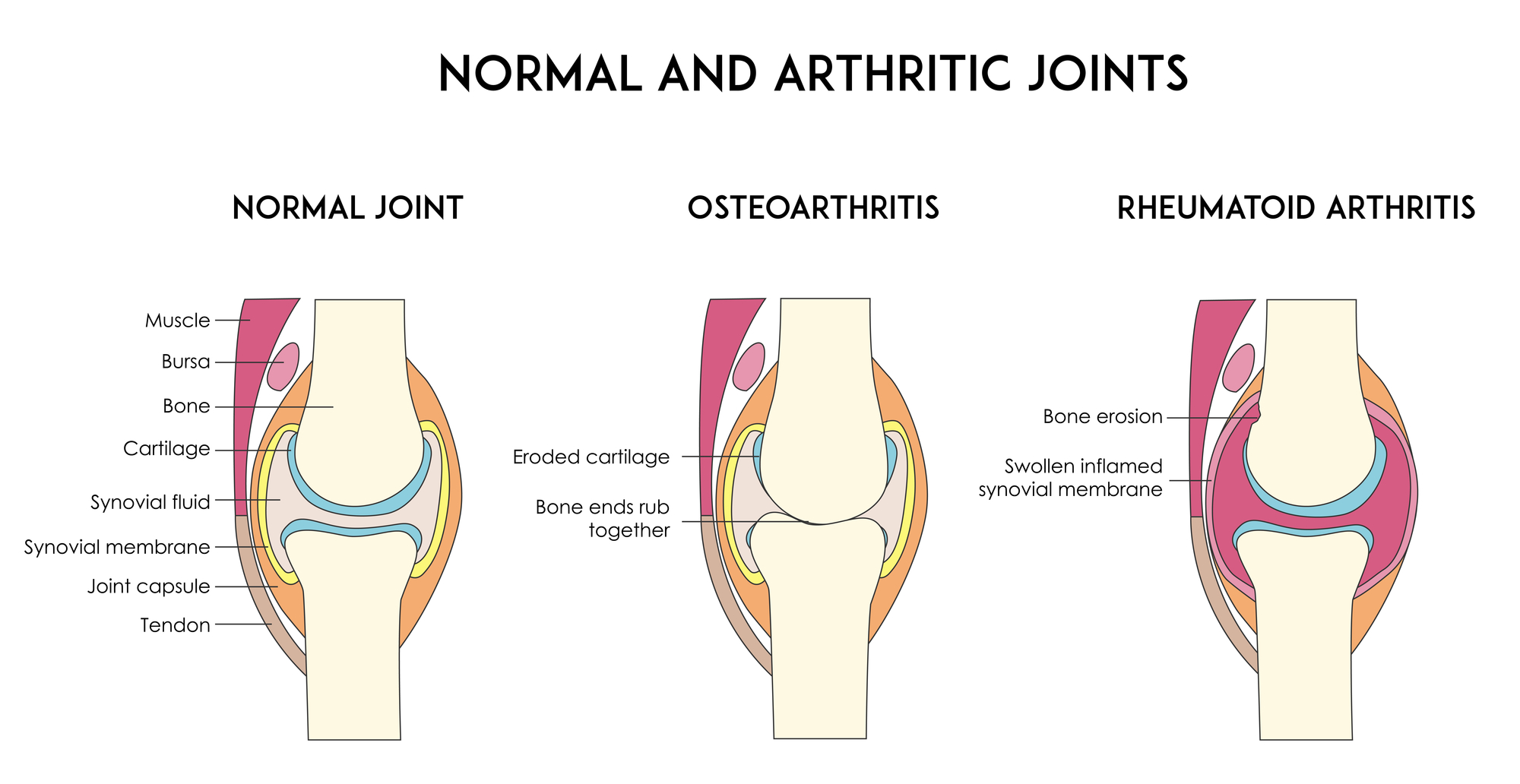 Diagram of normal joint and joints with osteoarthritis and rheumatoid arthritis