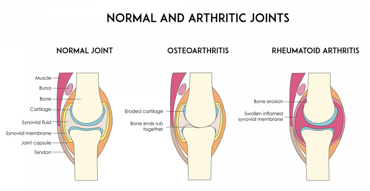 Diagram of normal joint and joints with osteoarthritis and rheumatoid arthritis