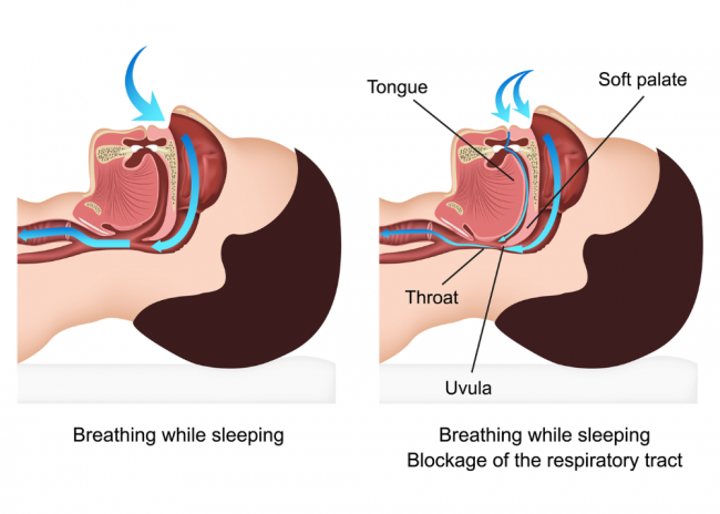 What happens when you breathe while sleeping and snore