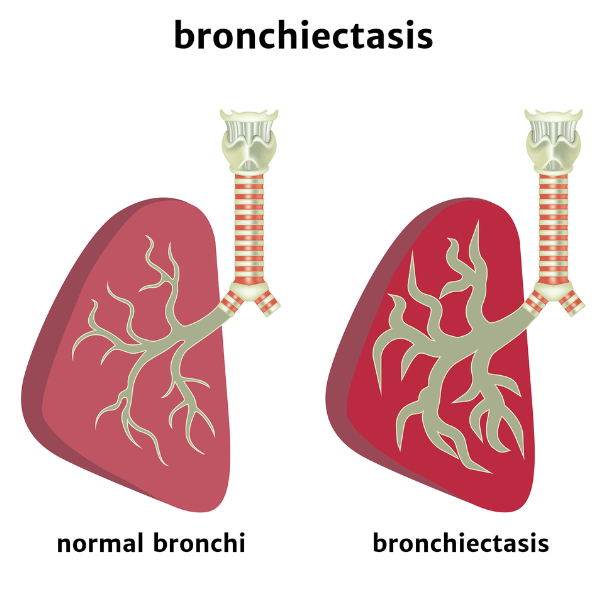 Image of normal lung and lung with bronchiectasis with enlarged bronchi