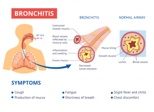 Image showing what happens to your airways if you have bronchitis and lists symptoms. 