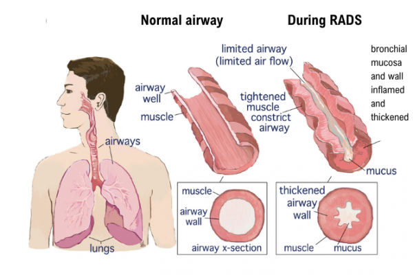 Effects of RADS on airways