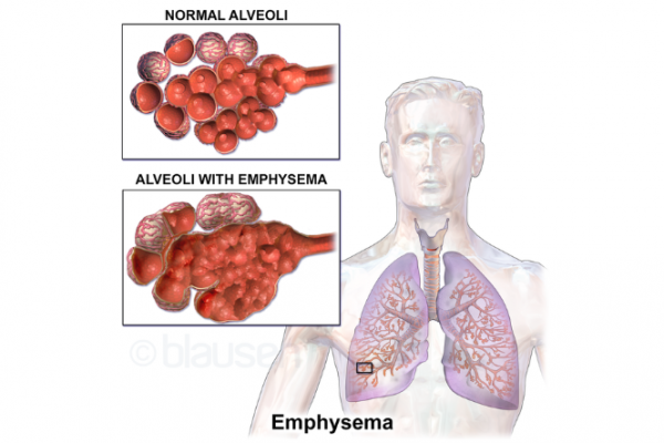 Lungs illustration showing normal alveoli and those affected by emphysema