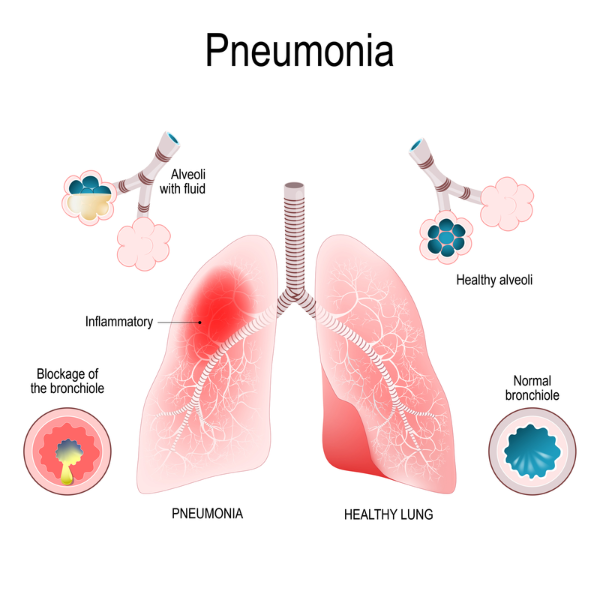 Image of healthy lung and lung with pneumonia