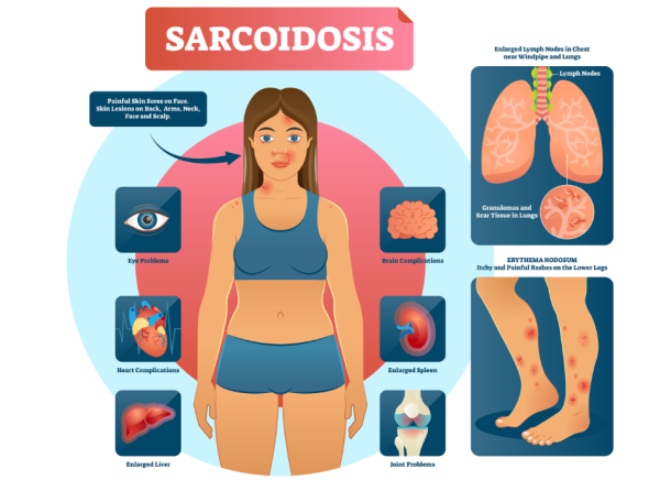 Signs and symptoms of sarcoidosis