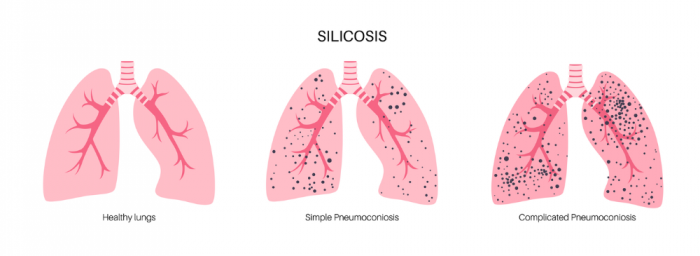 Lungs with silicosis