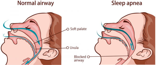 Image showing how airways collapse with obstructive sleep apnoea