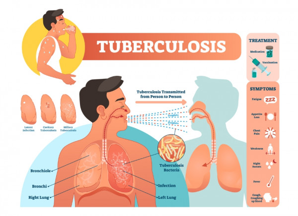 Tuberculosis, how it's transmitted, the symptoms and treatment