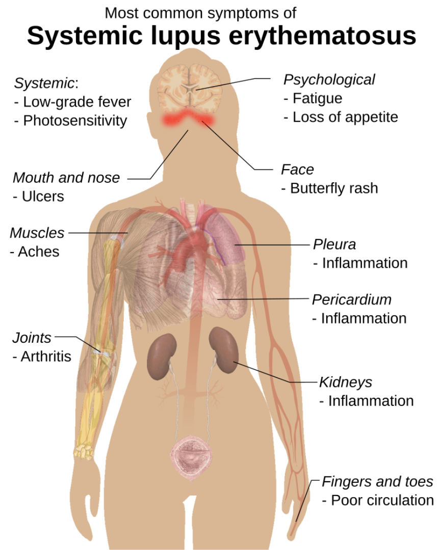 Graphic showing the most common symptoms of lupus