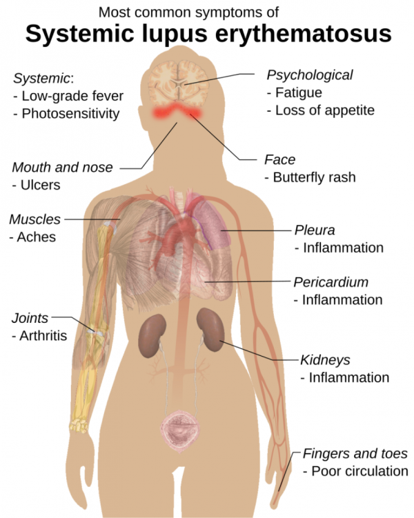 Graphic showing the most common symptoms of lupus