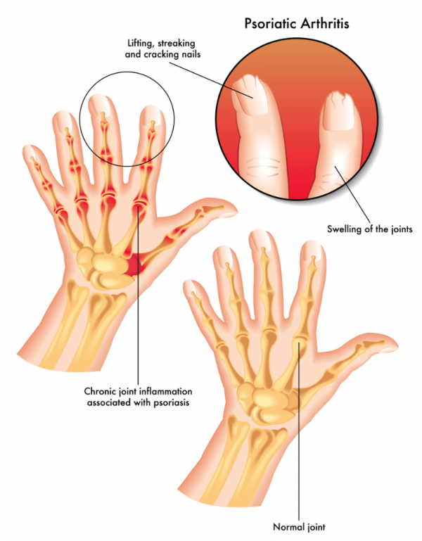 Effects of psoriatic arthritis on joints and nails