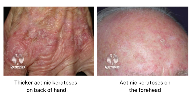 Actinic keratoses on a hand and a forehead