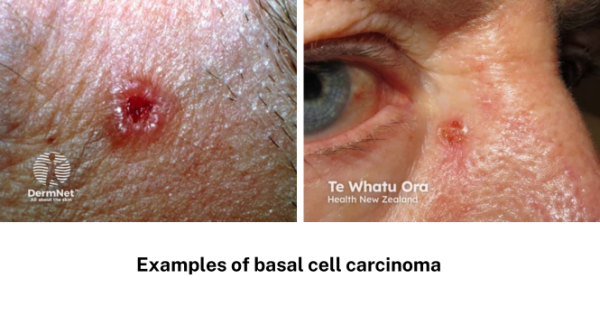 Basal cell carcinoma examples 