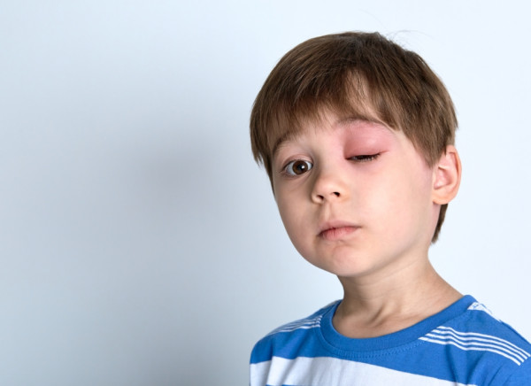 Boy with angioedema on his eyelid from an insect sting