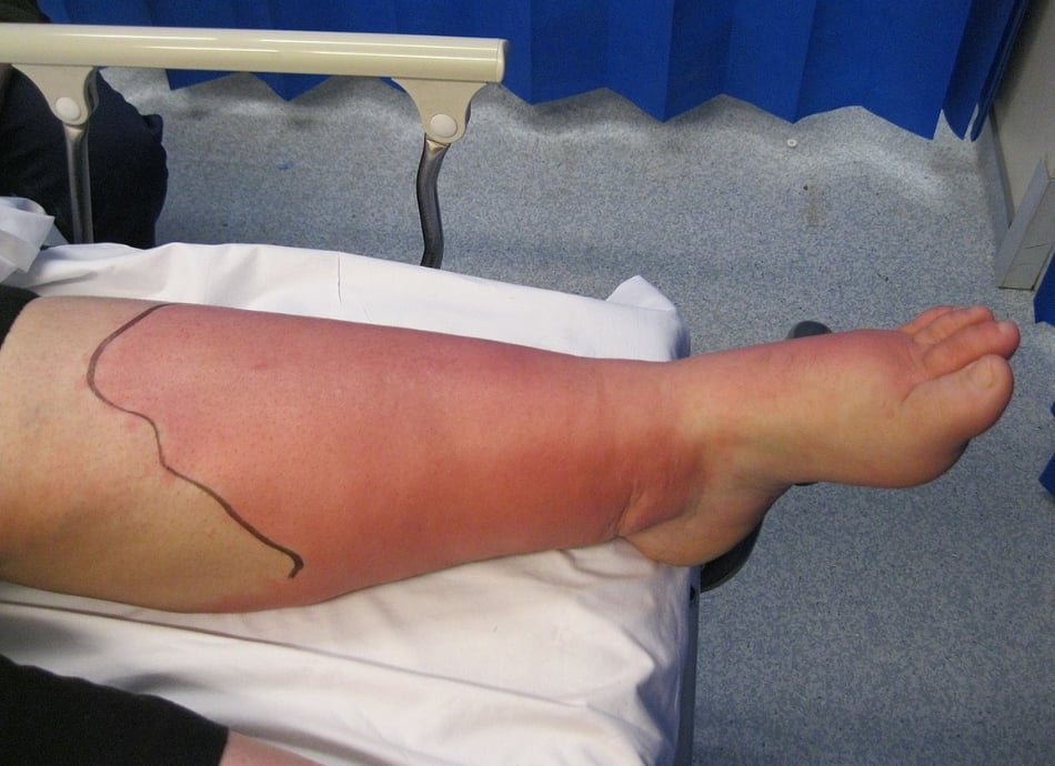 Cellulitis on lower leg 