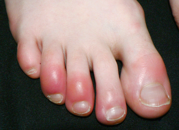 Reddened skin on toes due to chilblains