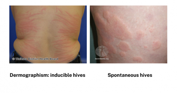 Images of inducible and spontaneous hives