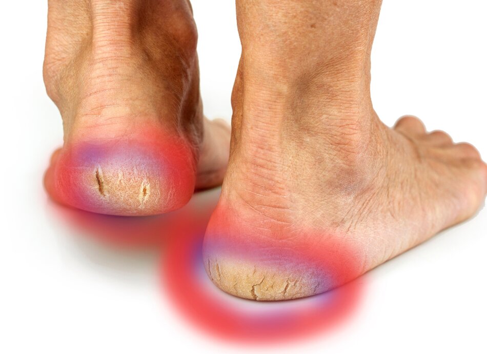 Cracked heel on foot Canva