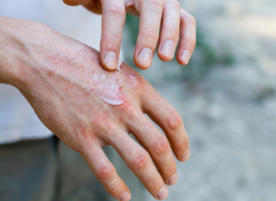 Cream being rubbed into irritated skin 