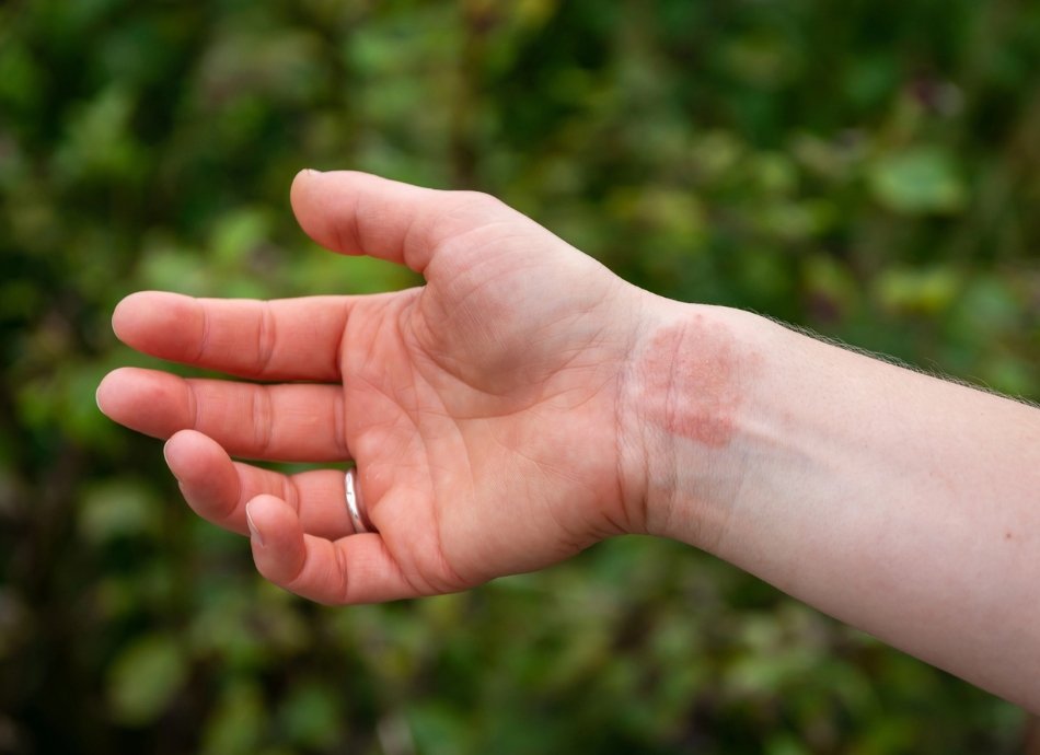 Eczema on inside of wrist 