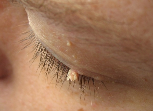 Filiform wart on eyelid