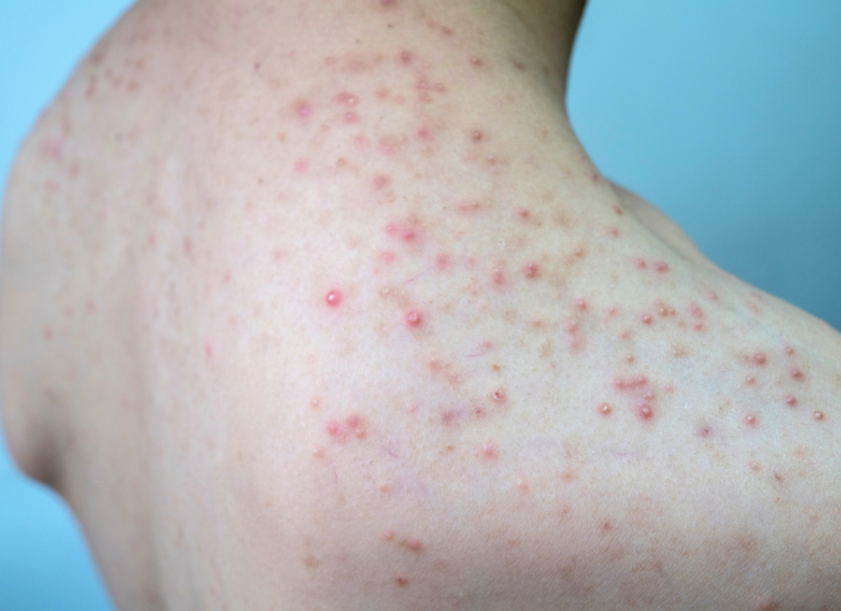 Folliculitis on shoulders 