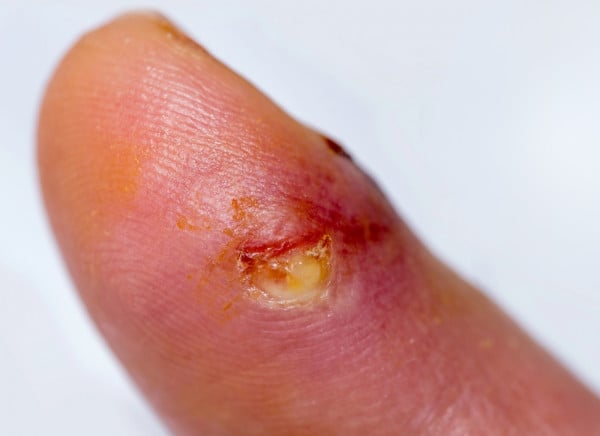 Infected cut on thumb