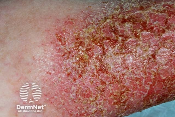 Infected eczema on arm