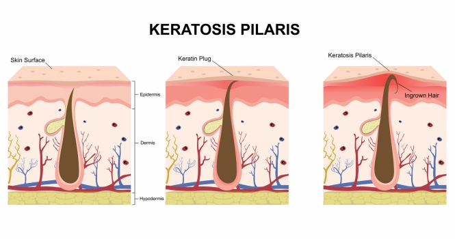 Diagram of the layers of skin showing how keratin blocks hair follicles