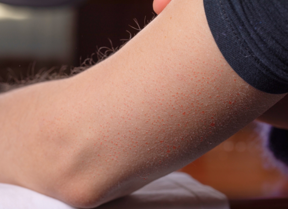 Keratosis pilaris on arm