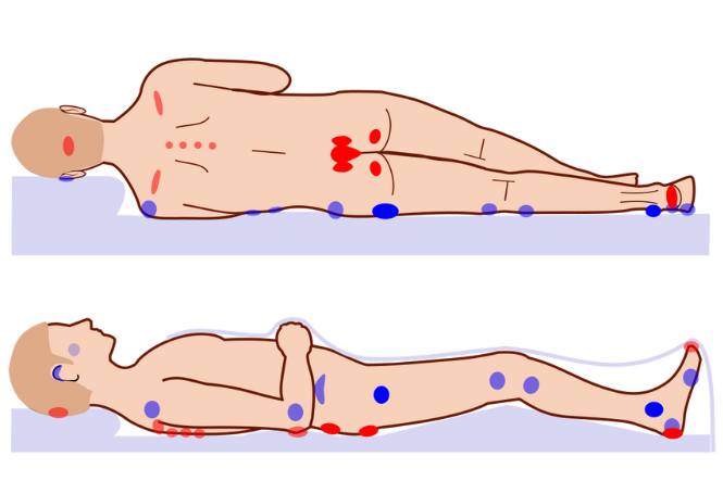Illustration of locations of pressure sores on the body