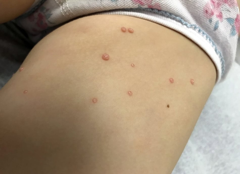 Molluscum contagiosum on leg 