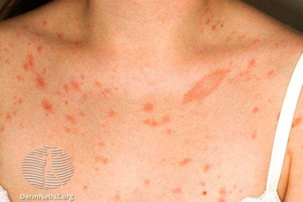 Pityriasis Rosea (Christmas Tree Rash): Pictures, Causes