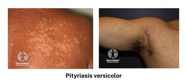 Pityriasis versicolor images from DermNet