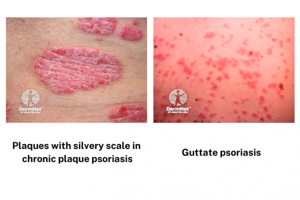 Two types of psoriasis, chronic plaque and guttate