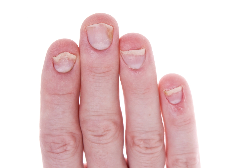 Psoriatic arthritis skin and nail changes 